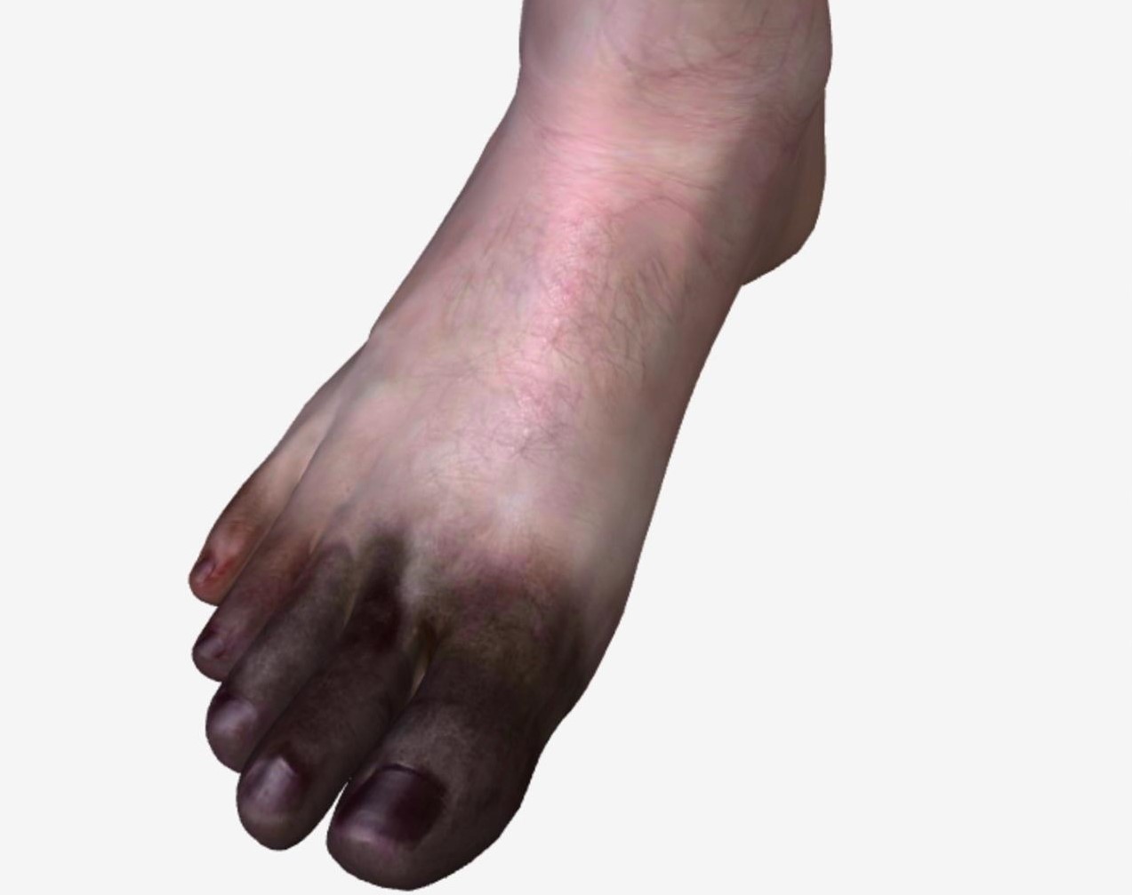 gangrene