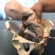 Breech Malpresentation