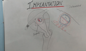 Implantation